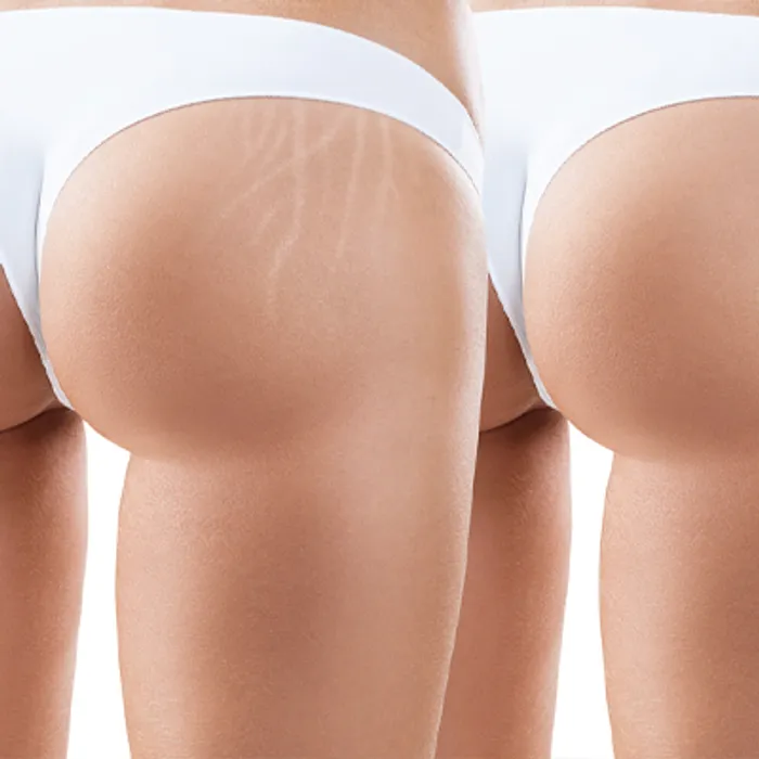Use Vitamin E Oil For Stretch Marks