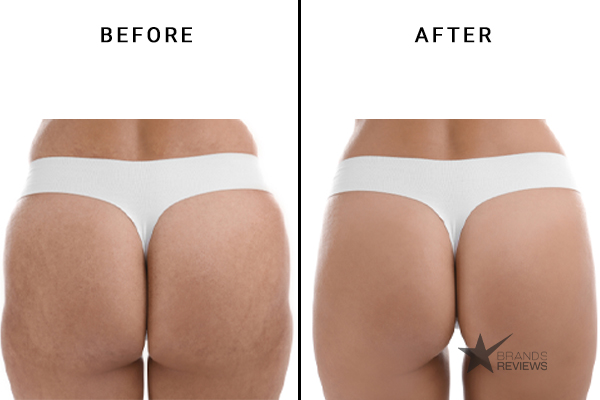 Bliss Cellulite Cream Before and After photo