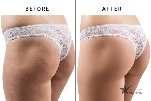 CelluAid Cellulite Cream Before and After