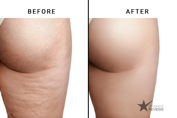 HydroXCell Cellulite Cream Before and After