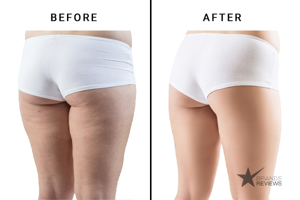 Life's Butter Cellulite Cream Before and After