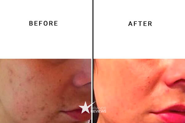 Murad Retinol Cream Before and After