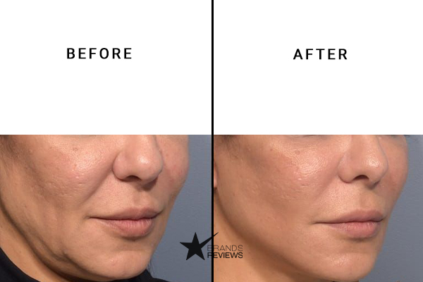 NourishMax Stem Cell Mask Before and After