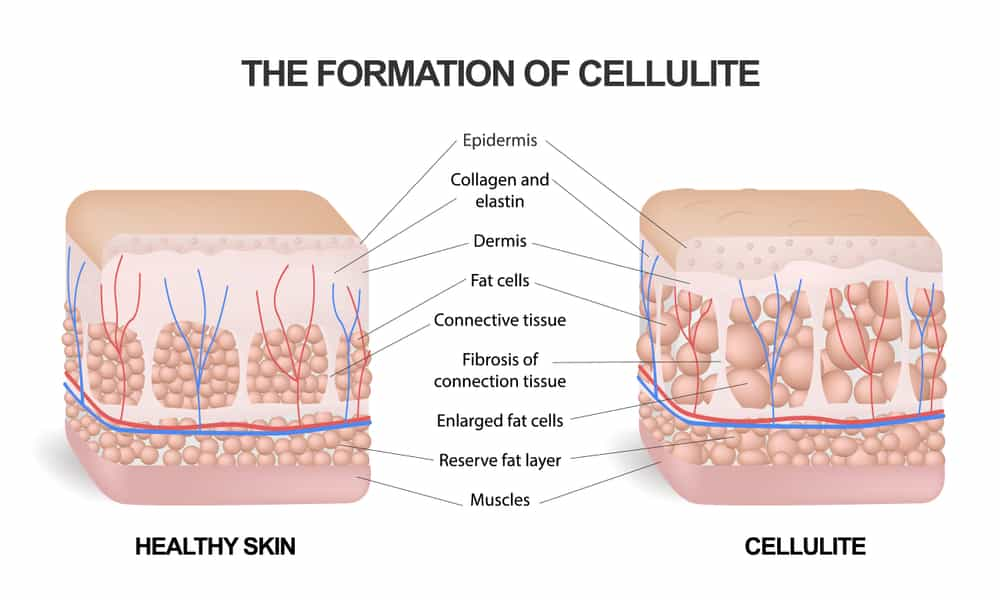 Anti-Cellulite Creams Work?