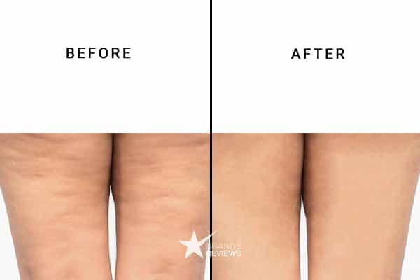 Augustinus Bader Cellulite Cream Before and After