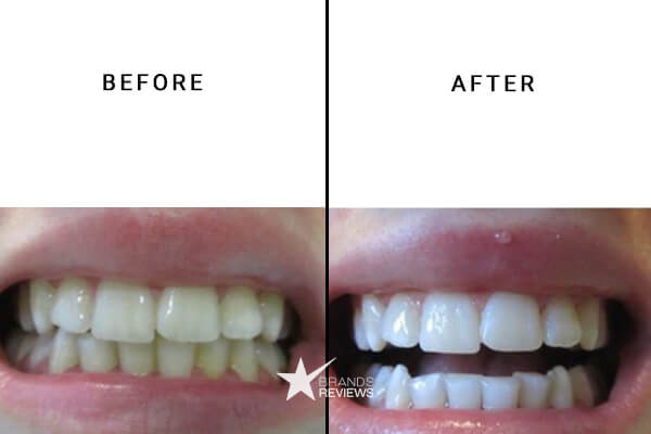 AuraGlow Teeth Whitening Kit Before and After