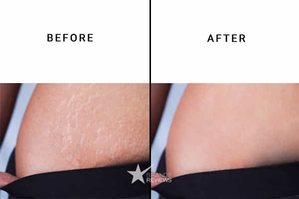 Bio-Oil Stretch Mark Cream Before and After