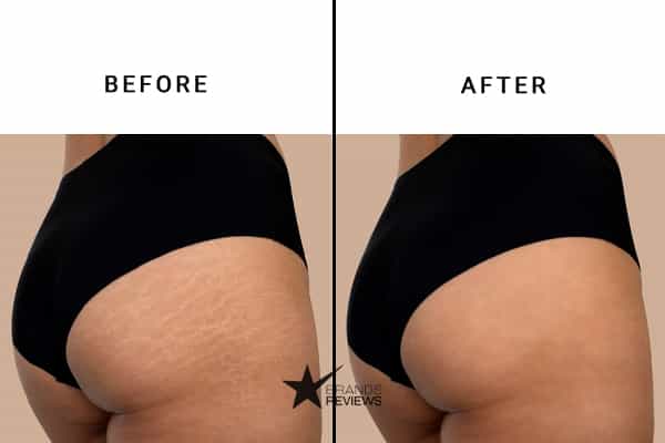Body Merry Stretch Mark Cream Before and After