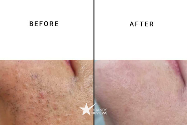 braun laser hair removal device before and after
