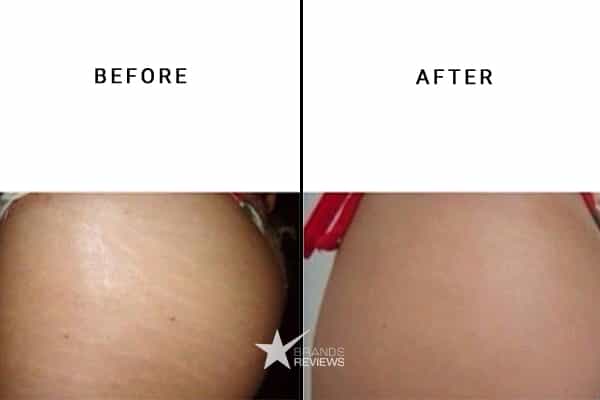 Burt's Bees Stretch Mark Cream Before and After