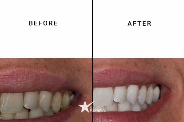 Cali White Teeth Whitening Kit Before and After