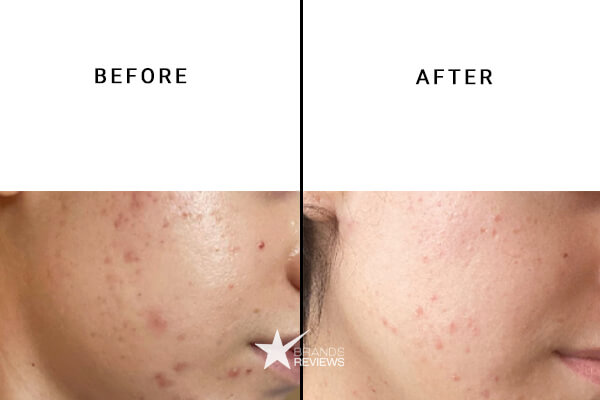 CBDistillery CBD Acne Cream Before and After
