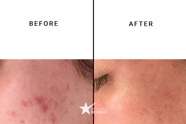 CBDMEDIC CBD Acne Cream Before and After