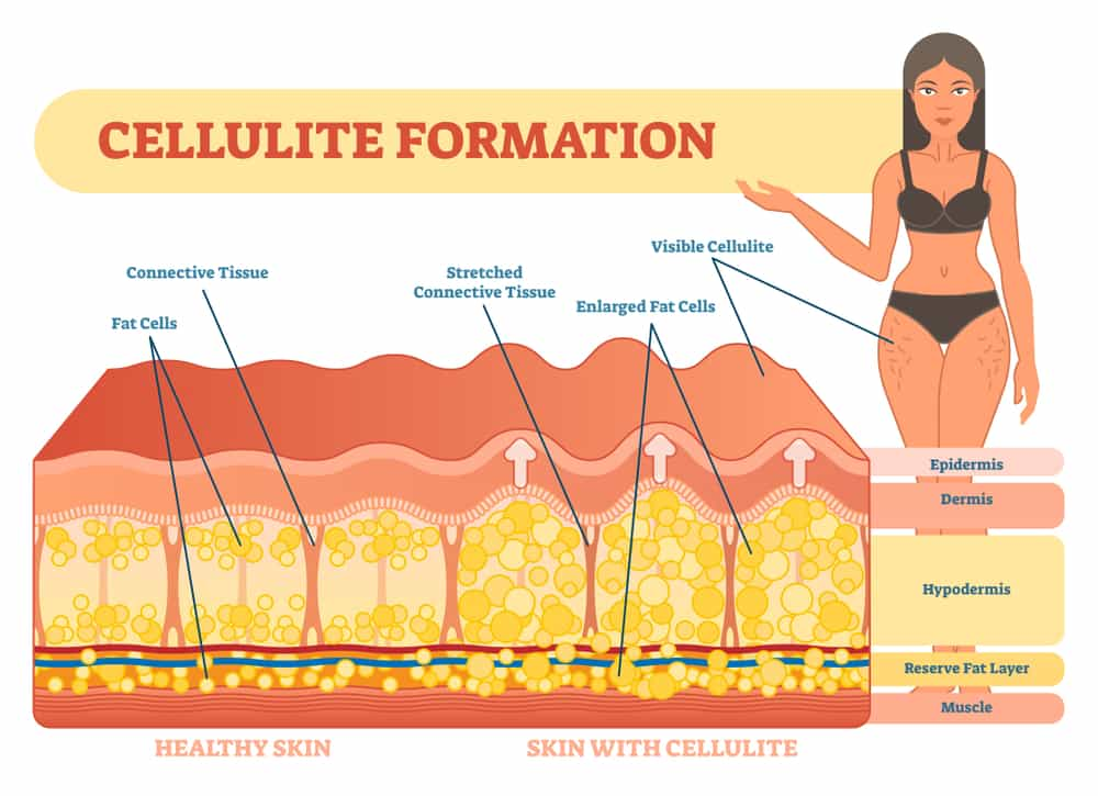 Cellulite Start