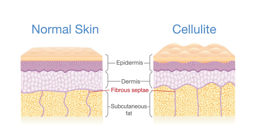 CELLULITE TREATMENT