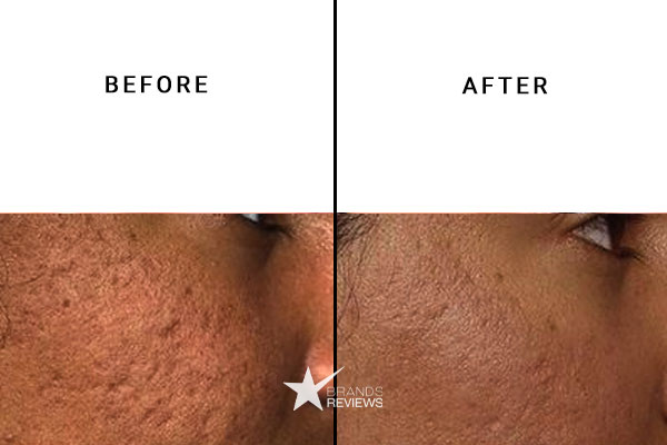 Cetaphil Face Cleanser Before and After