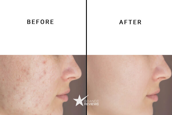 Charlotte's Web CBD Acne Cream Before and After