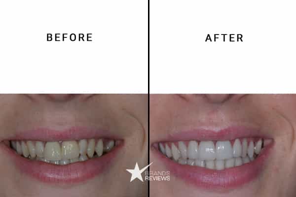 Colgate Teeth Whitening Kit Before and After