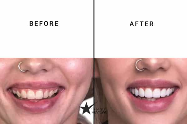 Crest Teeth Whitening Kit Before and After