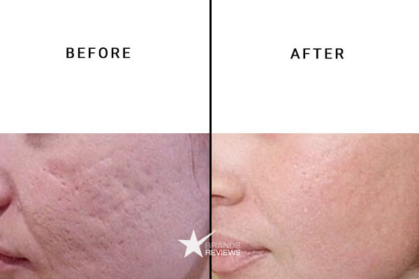 Cureganics CBD Acne Cream Before and After