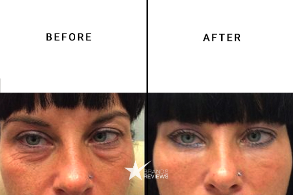 DermaSet Eye Cream Before and After