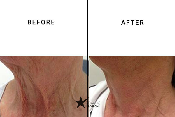 DermaSet Neck Firming Cream Before and After