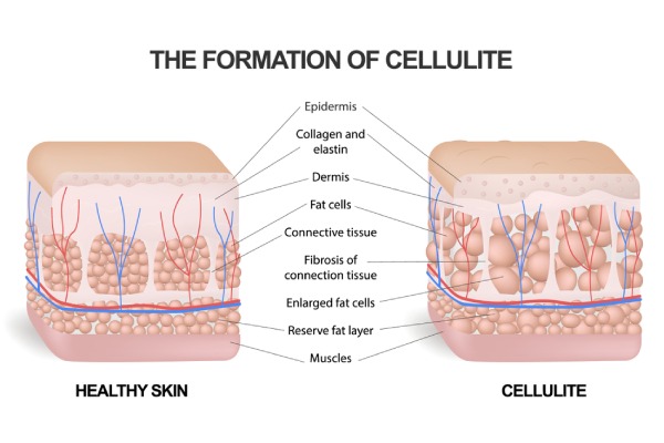 Does cellulite stay forever?