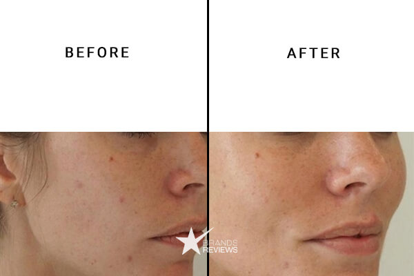 Dr. Dennis Gross Salicylic Acid Serum Before and After