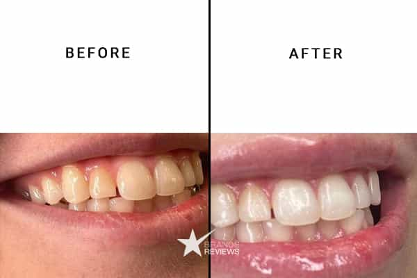 EasyWhite Teeth Whitening Kit Before and After