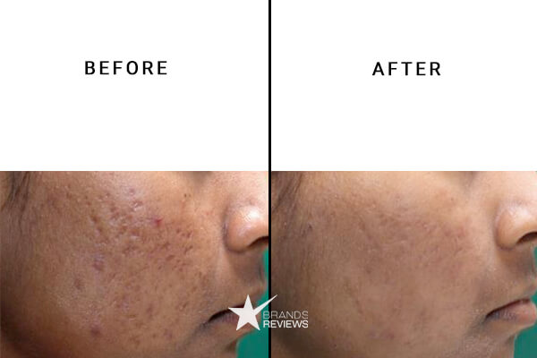 Endoca CBD Acne Cream Before and After