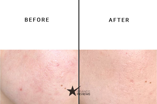 Exposed Skin Care Acne and Blemish Serum Before and After