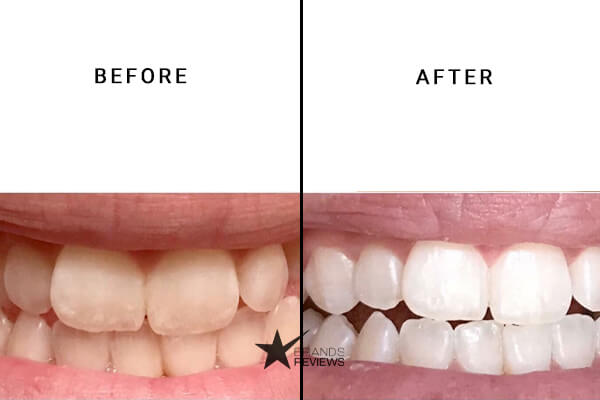 GLO Science Teeth Whitening Kit Before and After