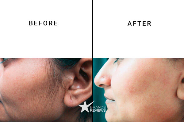 GlossRay laser hair removal device Before and After
