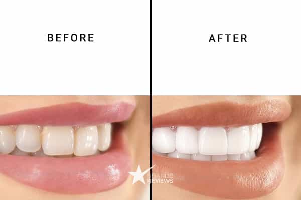 GlossRay Teeth Whitening Kit Before and After