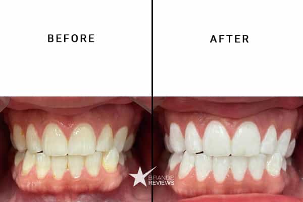 HiSmile Teeth Whitening Kit Before and After