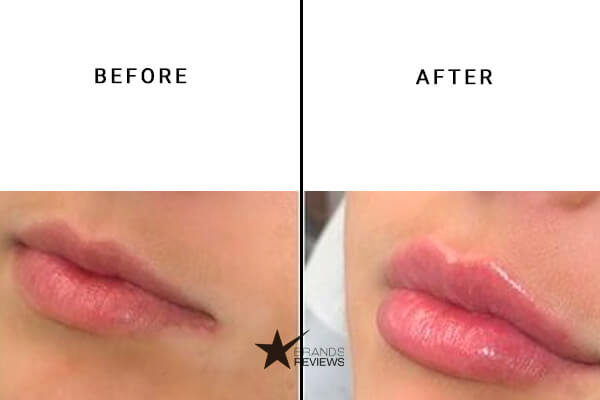 ignite cbd lip balm before and after