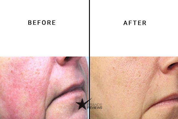 Isodiol cbd Face Cream Before and After