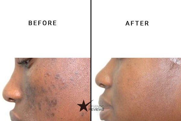 Juice Beauty Acne And Blemish Serum Before and After