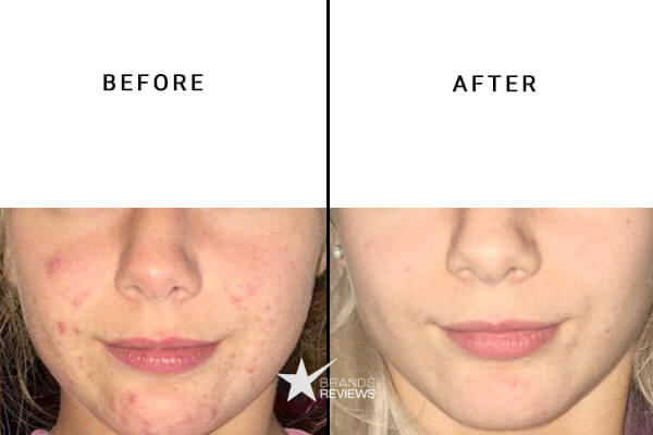 La Roche-posay Salicylic Acid Serum Before and After