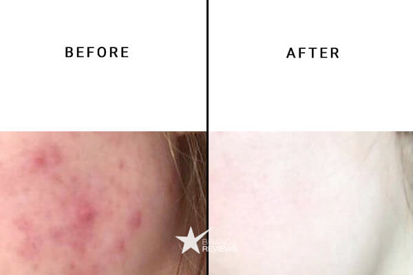 Lazarus Naturals CBD Acne Cream Before and After