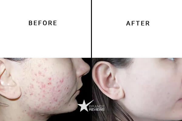 Medaims CBD Acne Cream Before and After