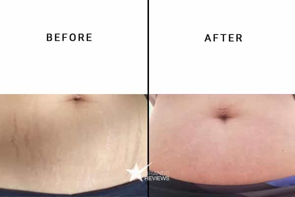 Mederma Stretch Mark Cream Before and After