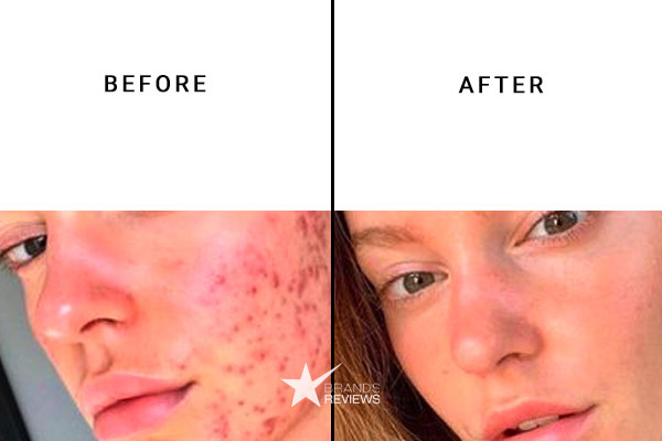 Neutrogena Face Cleanser Before and After