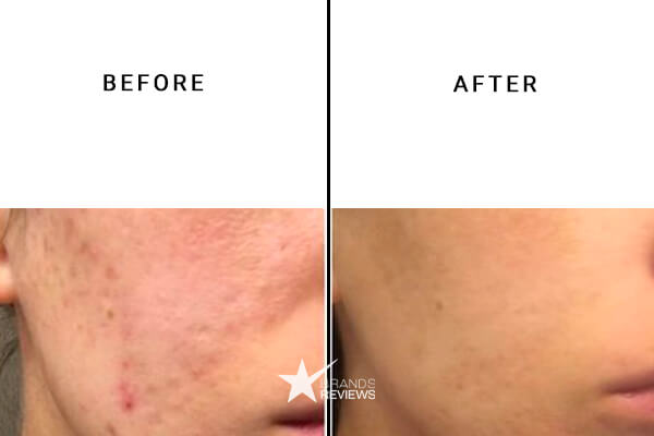 Neutrogena Retinol Cream Before and After