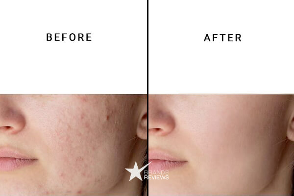 New Phase Blends CBD Acne Cream Before and After