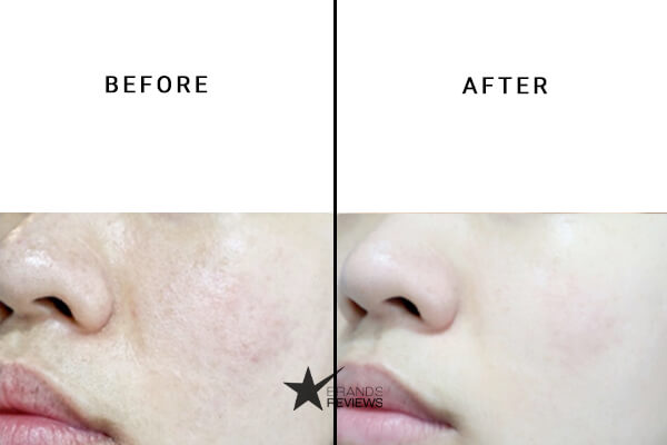 NourishMax Acne And Blemish Serum Before and After