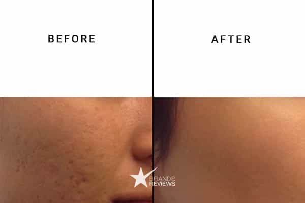 NourishMax Hyaluronic Acid Serum Before and After