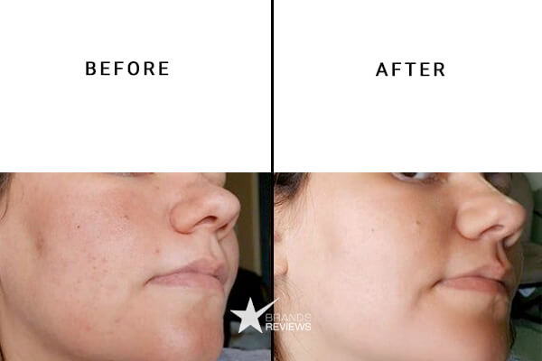 NourishMax Salicylic Acid Serum Before and After