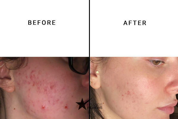 Nuventin Vitamin C Serum Before and After