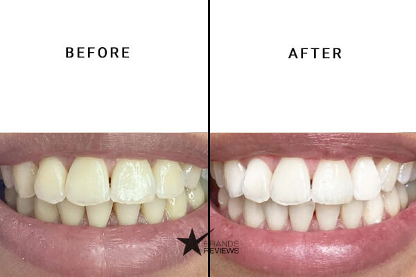 ORALGEN Nupearl Teeth Whitening Kit Before and After